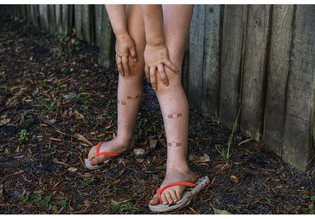 Pieter Hugo - Mosquito bites, Nature’s Valley, 2016